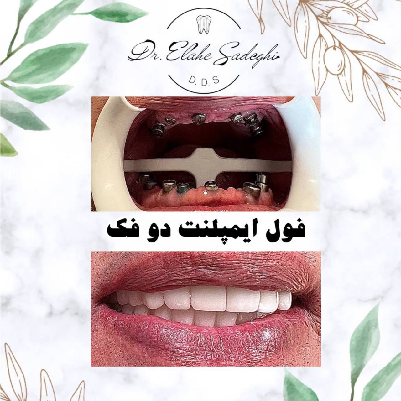 عملکرد ایمپلنت چگونه است؟