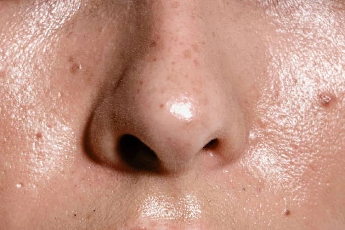 راهکار های خلاص شدن از چربی بینی