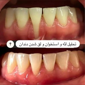 همه چیز درباره انواع بیماری لثه