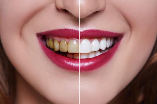 لمینت دندان برای چه سنی مناسب است؟