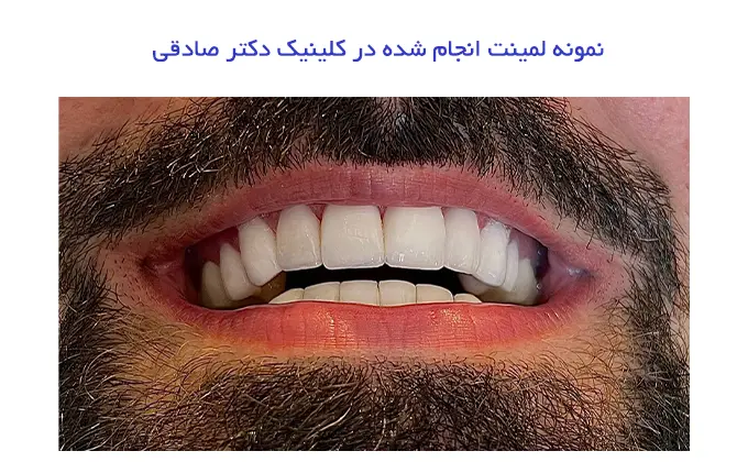 بهترین متخصص لمینت در تهران