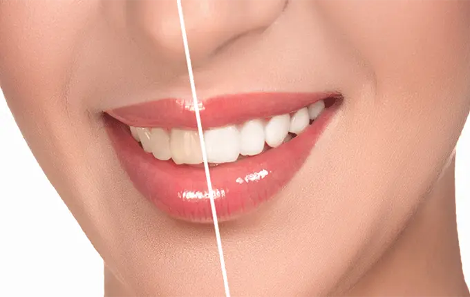 آیا سفیدی لمینت دندان همیشگی است؟