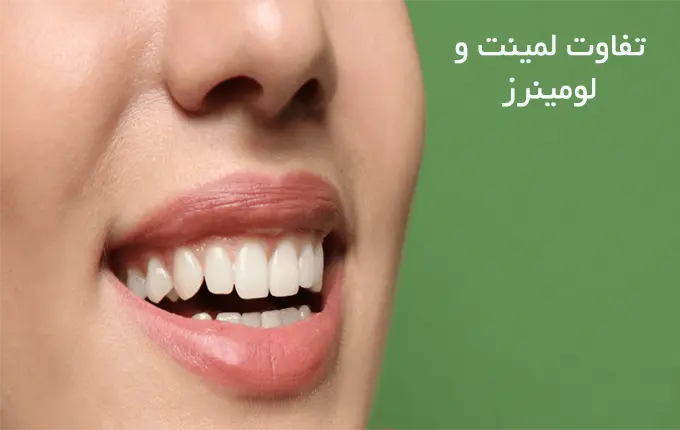 تفاوت لمینت و لومینیرز؛ راهنمای جامع اصلاح لبخند