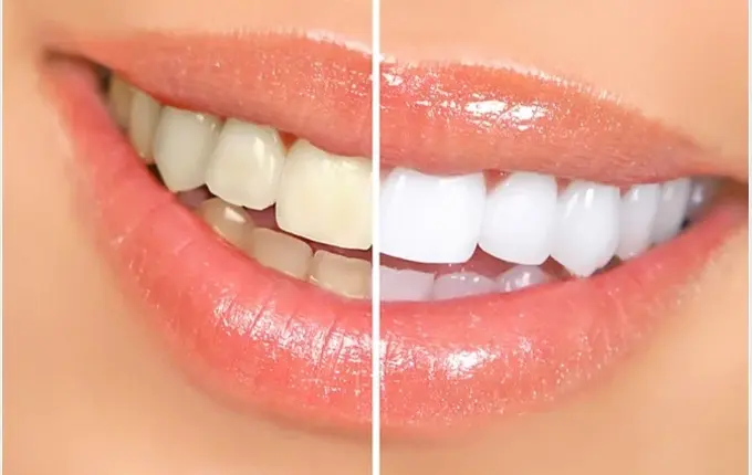 عوامل موثر بر هزینه بلیچینگ دندان 1402