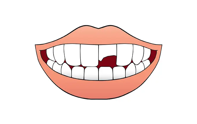 راه‌های درمان شکستگی دندان