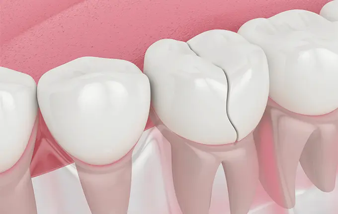 شناخت علل شکستگی دندان