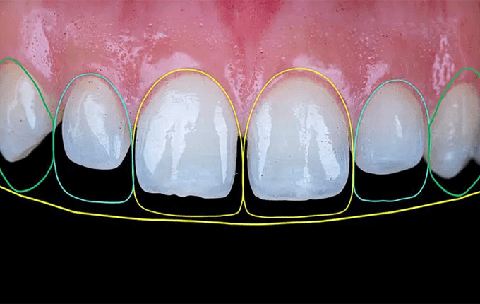 روش های ترمیم دندان های قدامی