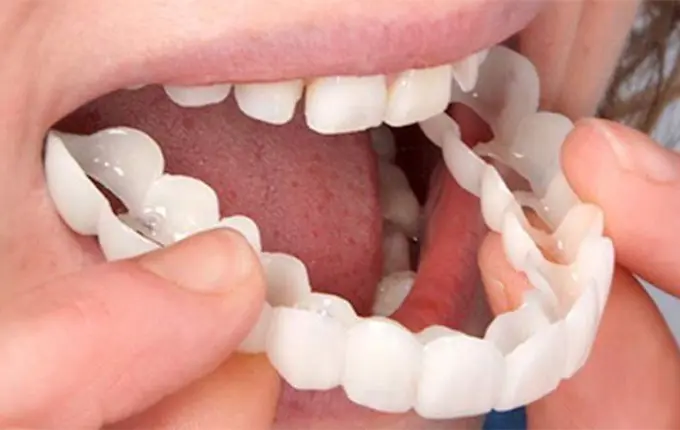 مراحل استفاده از روکش های فوری دندان