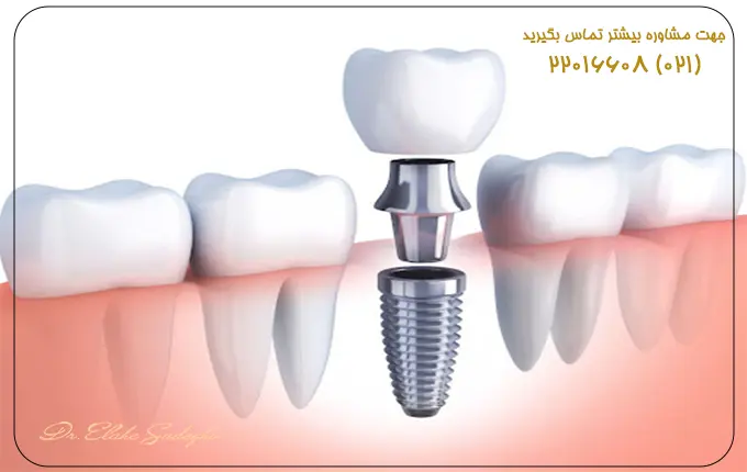 راهنمای جامع انواع ایمپلنت دندانی