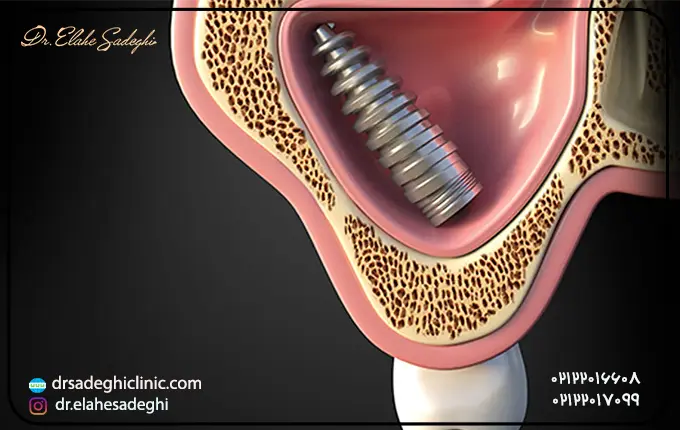 6 عارضه ایمپلنت دندان چیست؟ 