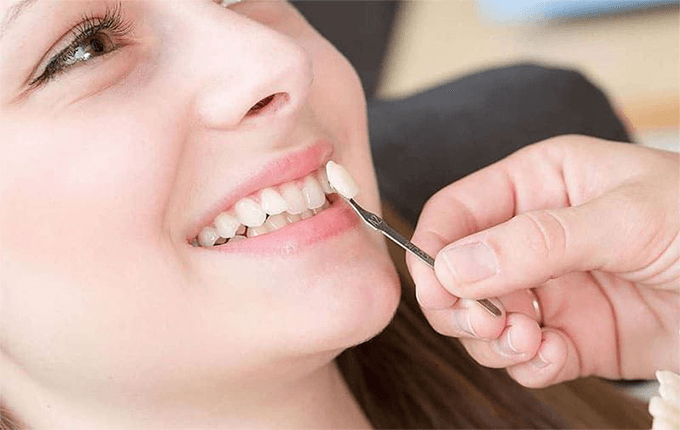 تاثیر سن بیمار در انتخاب کامپوزیت یا لمینت دندان