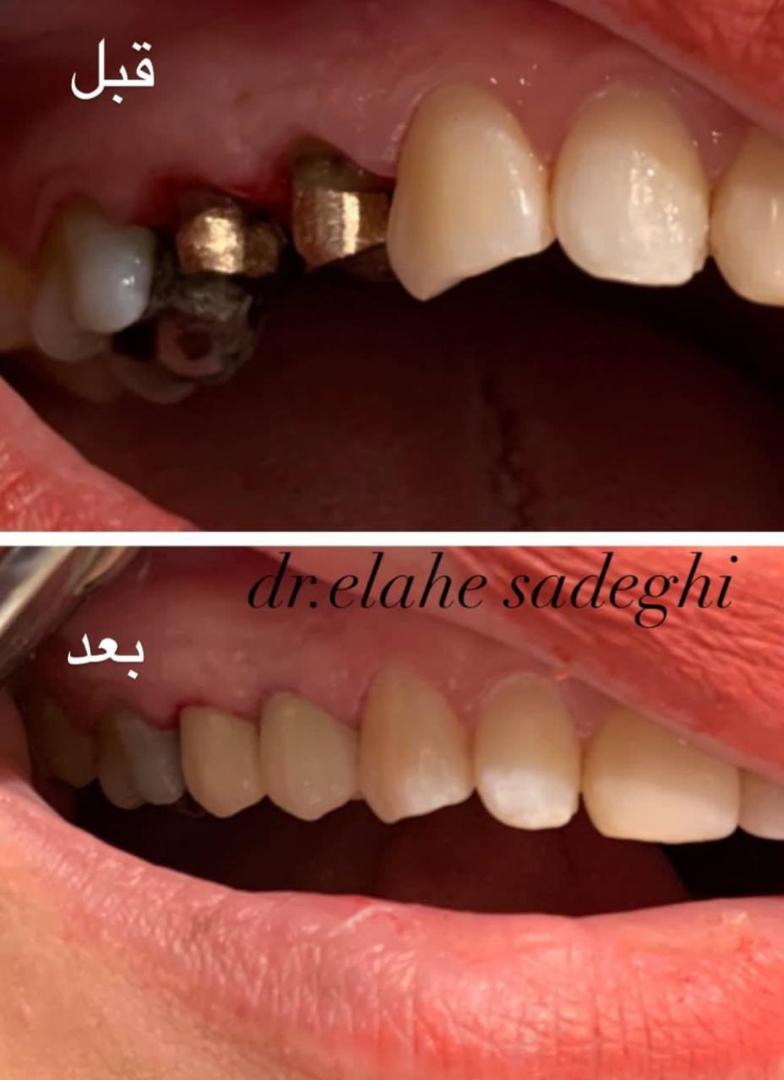 قیمت روکش دندان