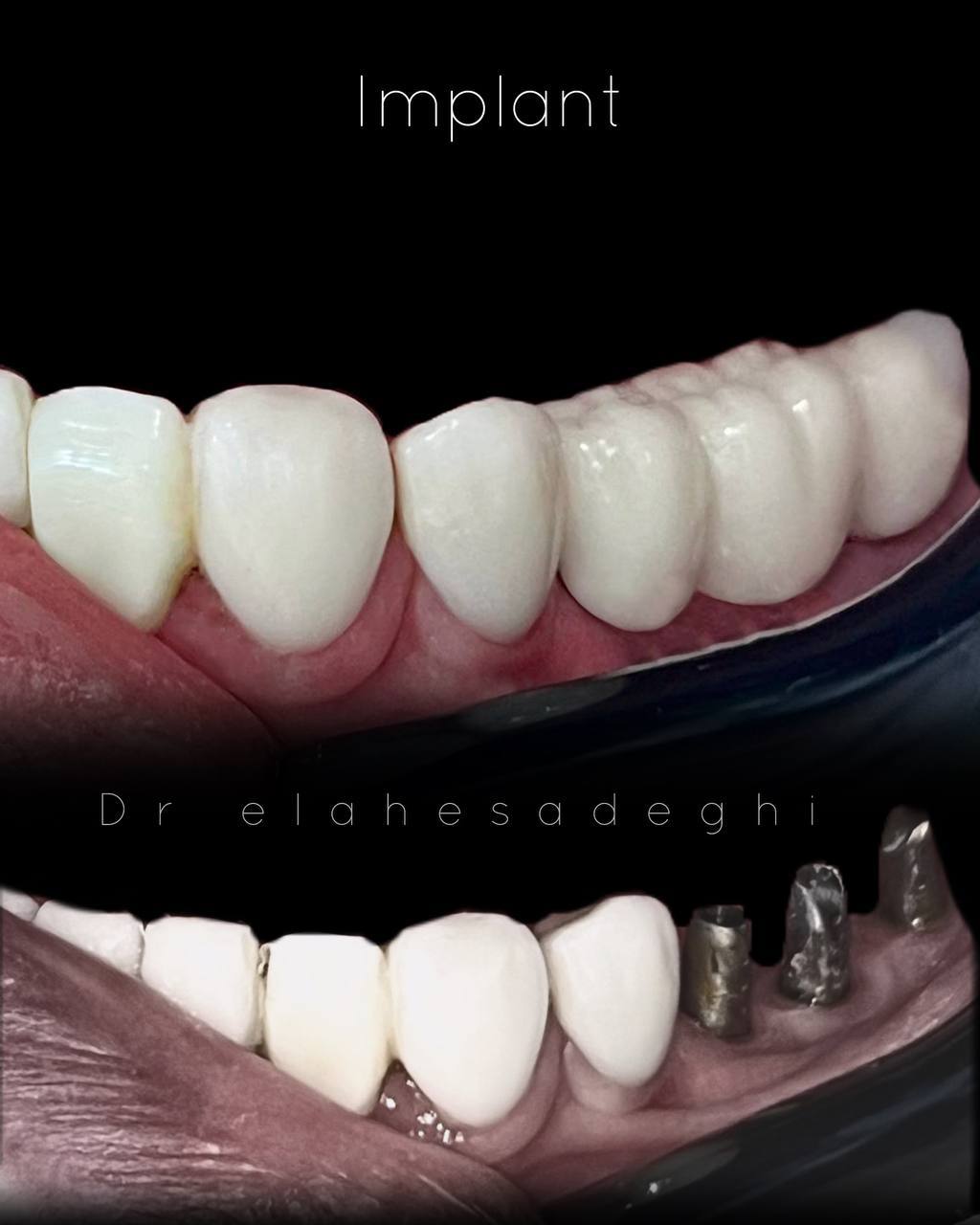 ایمپلنت دیجیتال نمونه 2