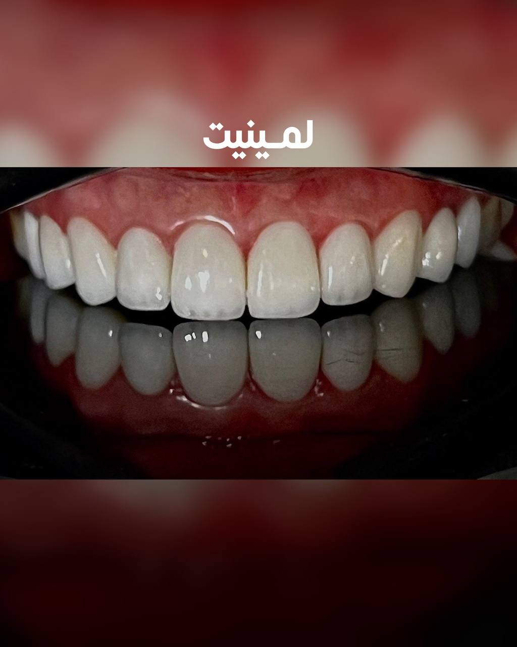 لمینت کامپوزیتی یا لمینت سرامیکی