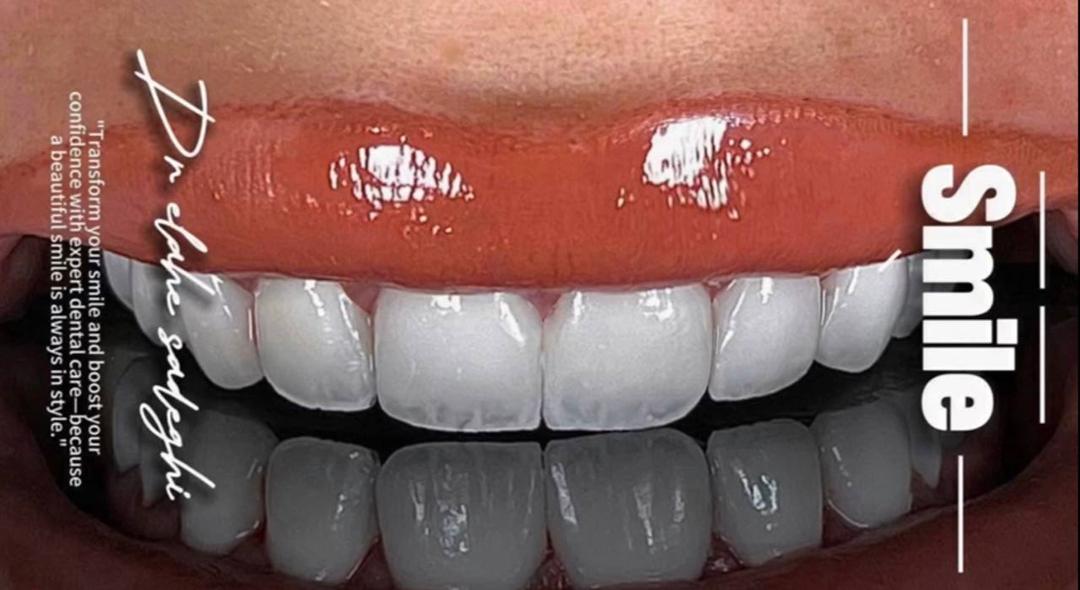 چه کسانی میتوانند دندان های خود را لمینت کنند؟