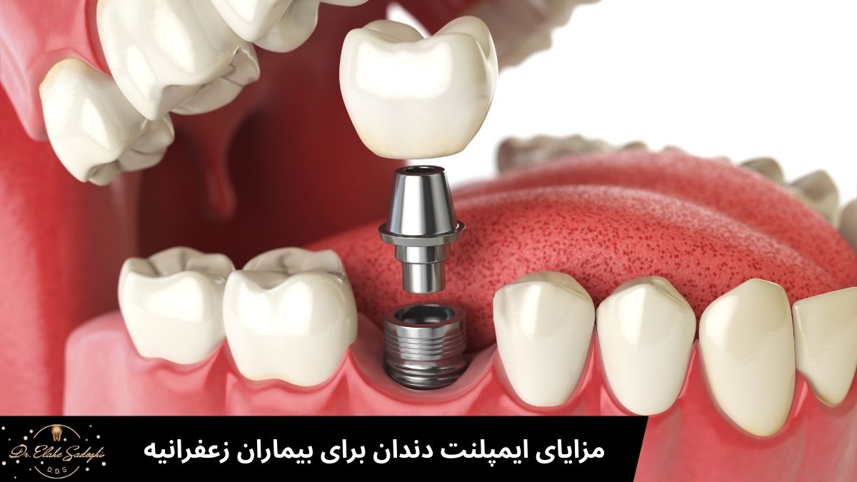 مزایای ایمپلنت دندان برای بیماران زعفرانیه