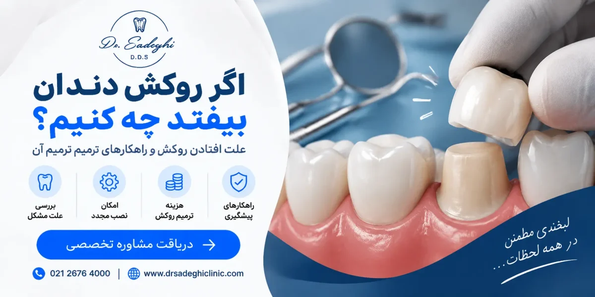 افتادن روکش دندان