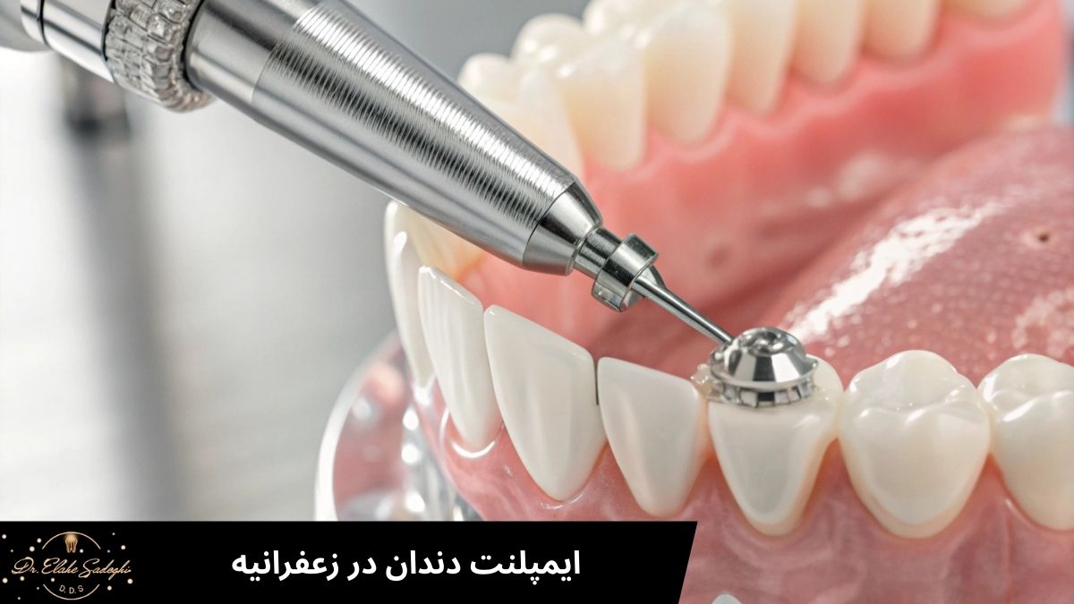 ایمپلنت دندان در زعفرانیه