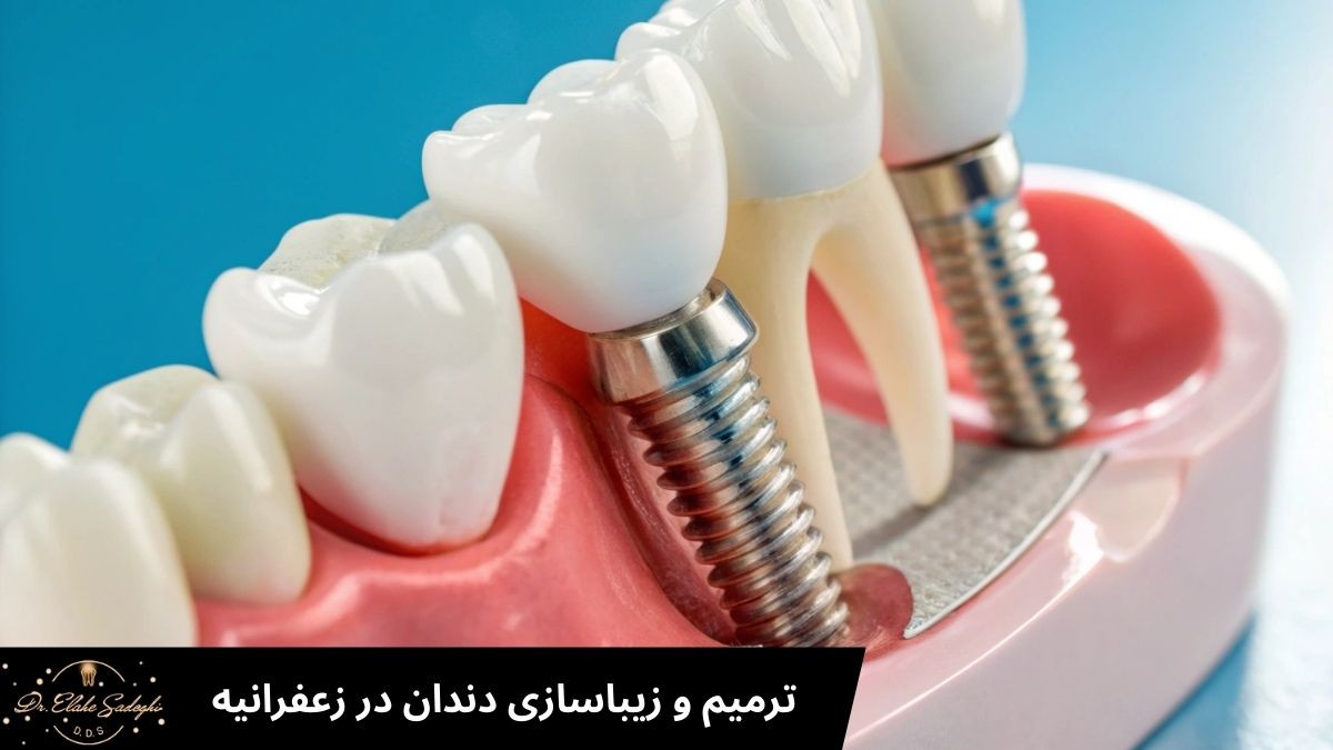 ترمیم و زیباسازی دندان در زعفرانیه