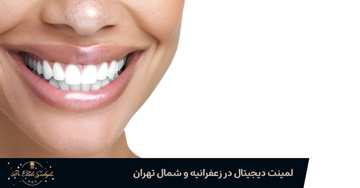 لمینت دیجیتال در زعفرانیه و شمال تهران
