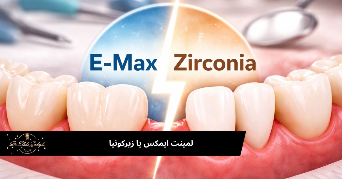 لمینت ایمکس یا زیرکونیا