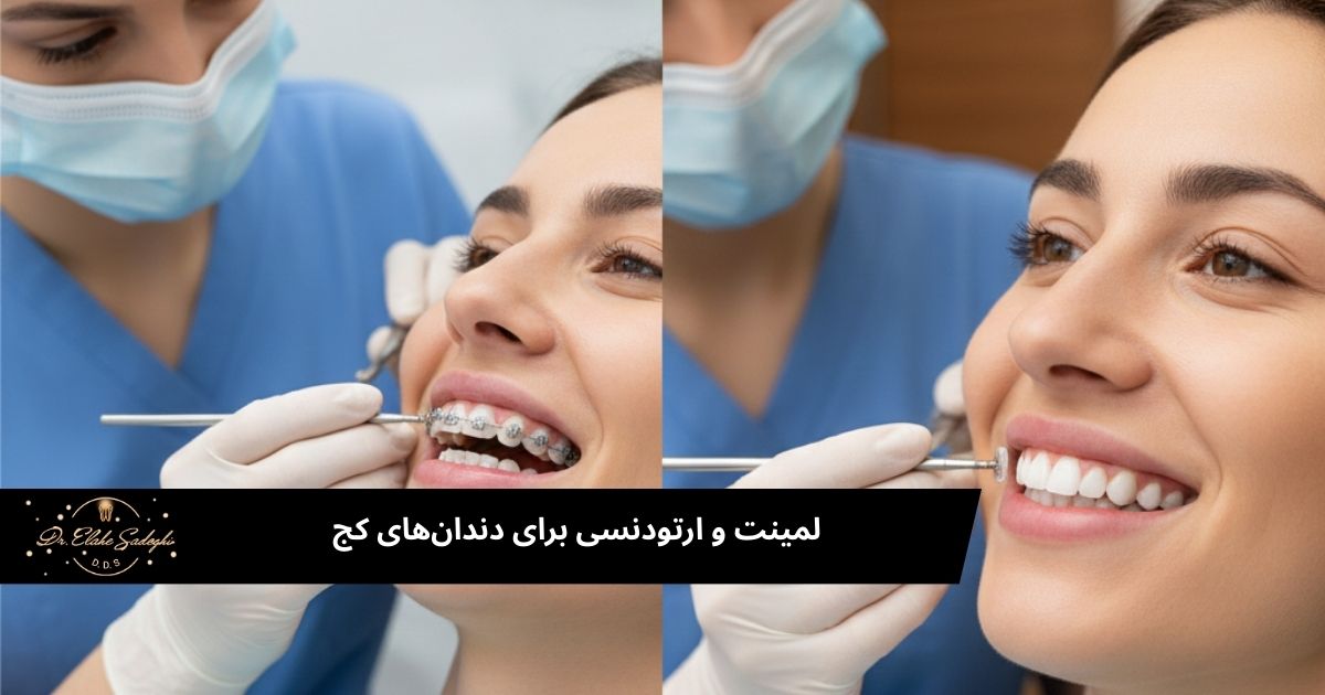 لمینت و ارتودنسی برای دندان‌های کج