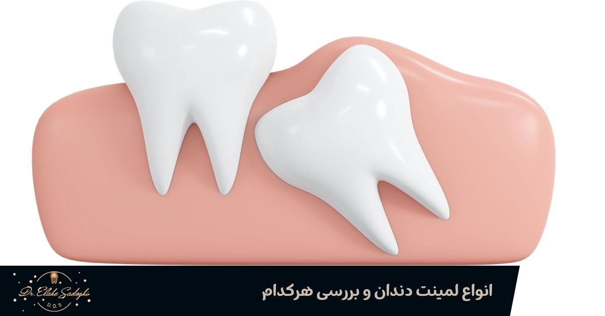 انواع لمینت دندان و بررسی هرکدام