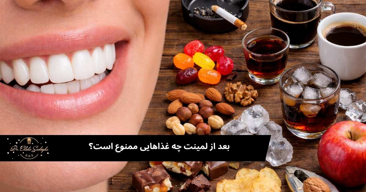 بعد از لمینت چه غذاهایی ممنوع است؟