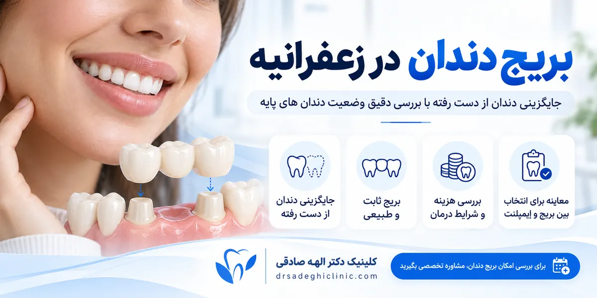 اینفوگرافی بریج دندان در زعفرانیه و جایگزینی دندان از دست رفته در کلینیک دکتر الهه صادقی