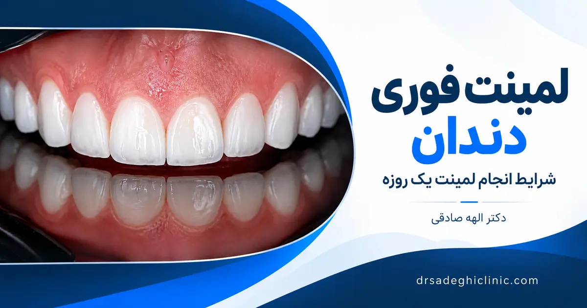 لمینت فوری