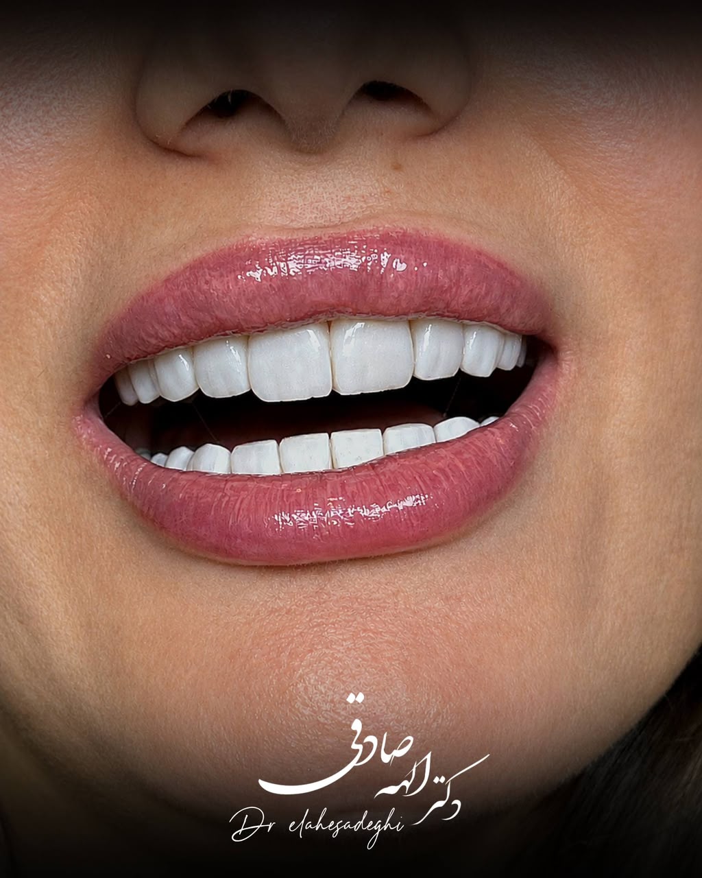 ایمپلنت دندان دکتر صادقی