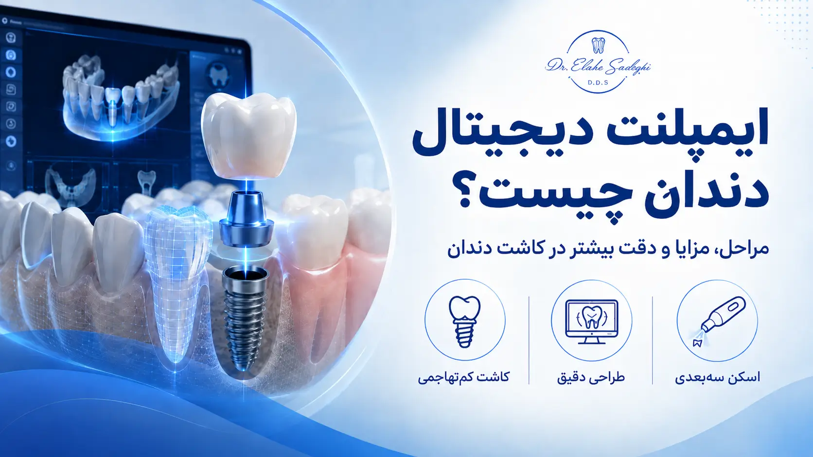 ایمپلنت دیجیتال