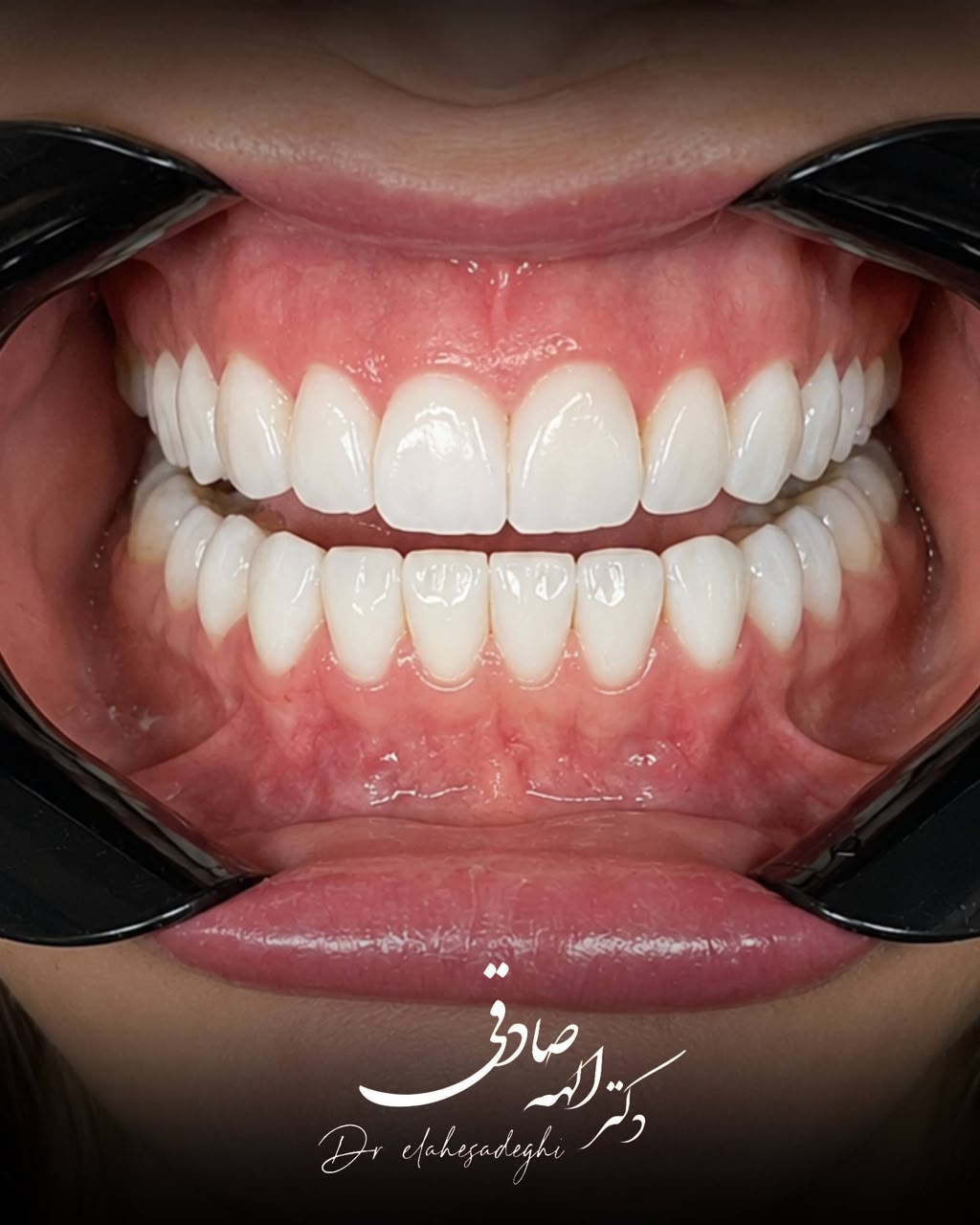 لمینت دندان